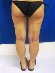 ②術後　1ヶ月後面